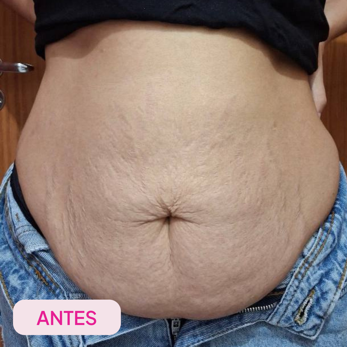 Pele antes do tratamento com ADEUS